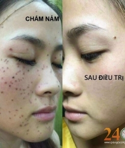 Spa Trị Mụn, Trị Nám, Tàn Nhang Uy Tín Hiệu Qủa Quận 12